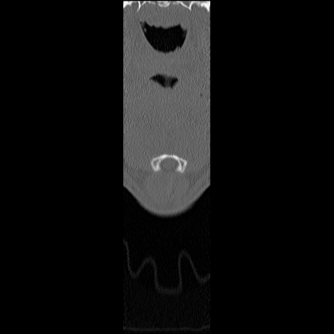 C5 facet fracture (Radiopaedia 58374-65499 Coronal bone window 2).jpg
