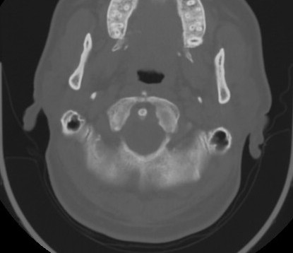 C7 laminar fracture and Klippel-Feil syndrome (Radiopaedia 86710-102850 Axial bone window 21).jpg