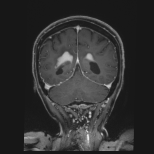 CNS lymphoma with steroid response (Radiopaedia 37980-39921 Coronal T1 C+ 36).png