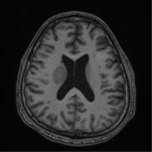 CNS vasculitis (Radiopaedia 55715-62263 Axial T1 49).png