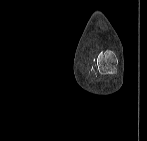 Calcaneal fracture - Sanders type 4 (Radiopaedia 90179-107370 Coronal bone window 82).jpg