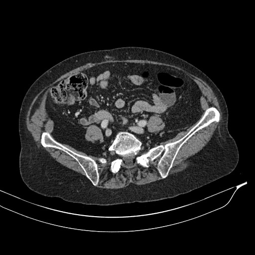 Calcified adrenal glands and Spigelian hernia (Radiopaedia 49741-54988 A 156).jpg