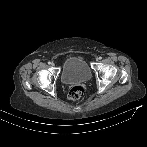 Calcified adrenal glands and Spigelian hernia (Radiopaedia 49741-54988 A 231).jpg