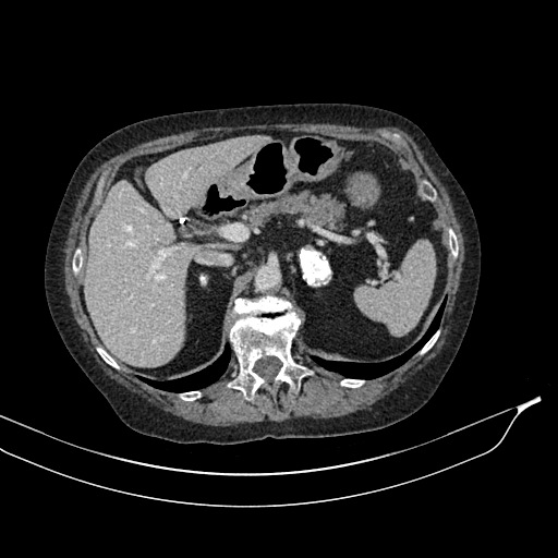 Calcified adrenal glands and Spigelian hernia (Radiopaedia 49741-54988 A 58).jpg