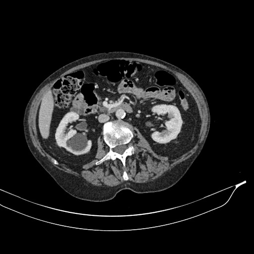 Calcified adrenal glands and Spigelian hernia (Radiopaedia 49741-54988 A 95).jpg