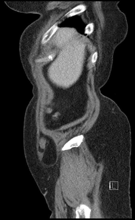 Calcified adrenal glands and Spigelian hernia (Radiopaedia 49741-54988 C 146).jpg