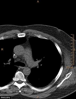 File:Calcified cardiac fibroma (Radiopaedia 39267-41519 Axial non-contrast 1).jpg