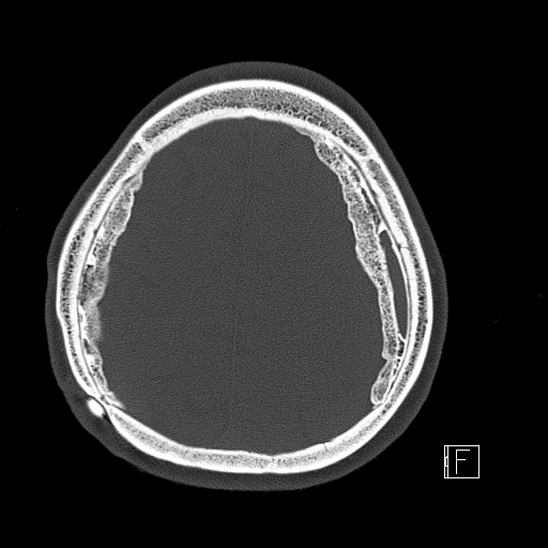 Calcified chronic subdural hematoma (Radiopaedia 77374-89492 Axial bone window 104).jpg