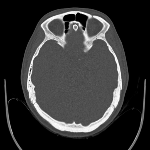 Calvarial osteoma (Radiopaedia 36520-38079 Axial bone window 38).jpg