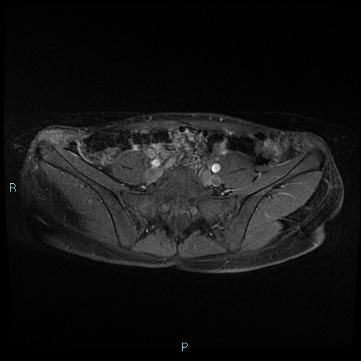 File:Canal of Nuck cyst (Radiopaedia 55074-61448 Axial T1 C+ fat sat 5).jpg