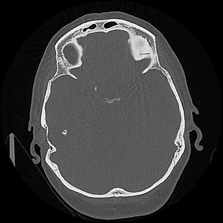 Canal up mastoidectomy (Radiopaedia 78108-90638 Axial bone window 114).jpg