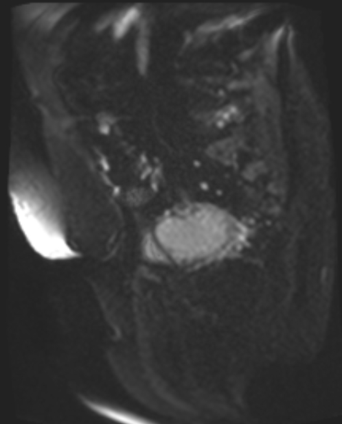 Cancer cervix - stage IIb (Radiopaedia 75411-86615 Sagittal DWI 41).jpg