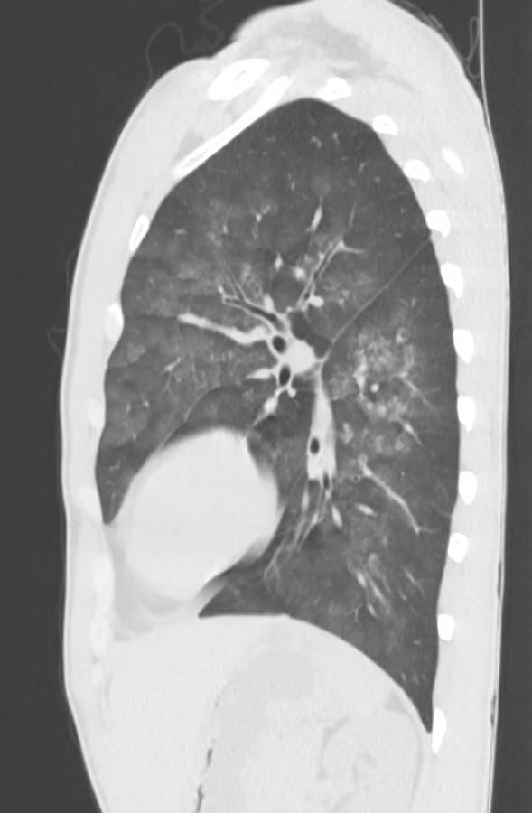 Cannabis-induced diffuse alveolar hemorrhage (Radiopaedia 89834-106946 Sagittal lung window 100).jpg