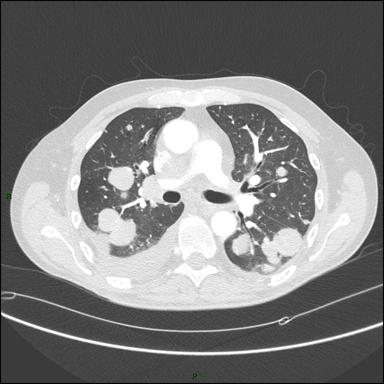 Cannonball metastases (Radiopaedia 82110-96150 Axial lung window 89).jpg