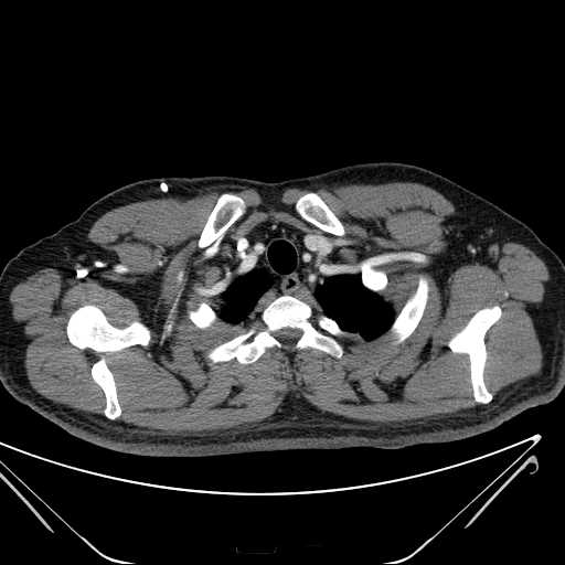 File:Cannonball pulmonary metastases (Radiopaedia 67684-77101 D 26).jpg
