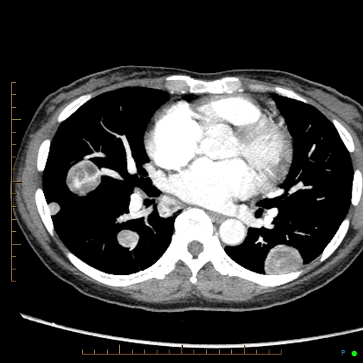 Canonball lung metastasis (Radiopaedia 77634-89837 B 55).jpg
