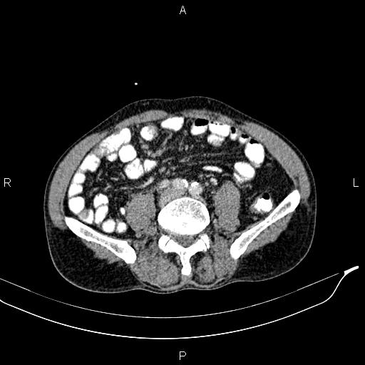 Caput medusae sign - portal hypertension (Radiopaedia 64007-72759 A 62).jpg