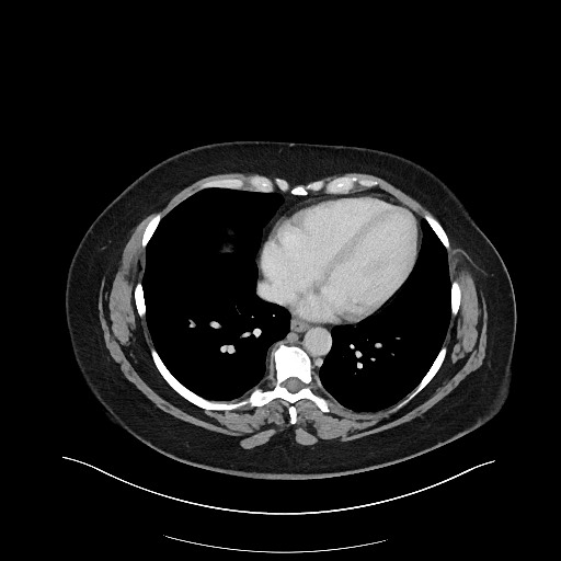 Carcinoid tumor - terminal ileum (Radiopaedia 60931-68739 A 5).jpg