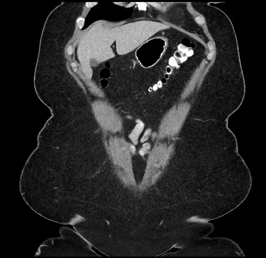 Carcinoid tumor - terminal ileum (Radiopaedia 60931-68739 B 4).jpg