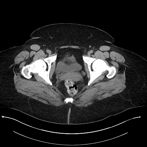 File:Carcinoid tumor - terminal ileum (Radiopaedia 60931-68740 Axial non-contrast 121).jpg