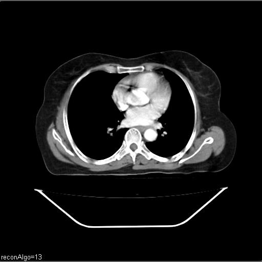 File:Carcinoma cervix- recurrence (Radiopaedia 34702-36137 B 1).jpg