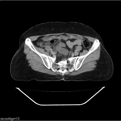 File:Carcinoma cervix- recurrence (Radiopaedia 34702-36137 B 40).jpg