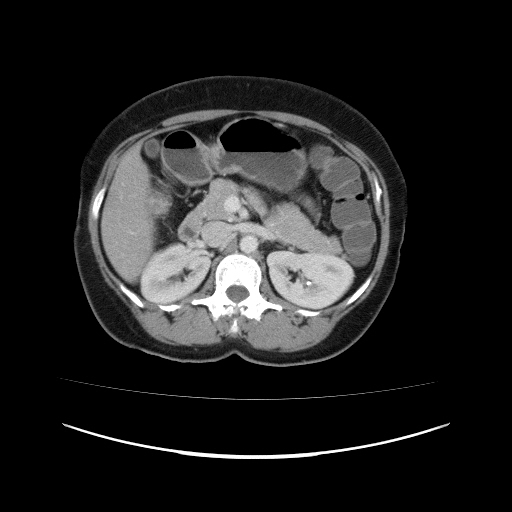 Carcinoma colon - hepatic flexure (Radiopaedia 19461-19493 A 46).jpg