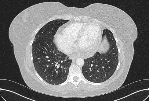 Cardiac sarcoidosis (Radiopaedia 74548-85534 Axial lung window 62).jpg