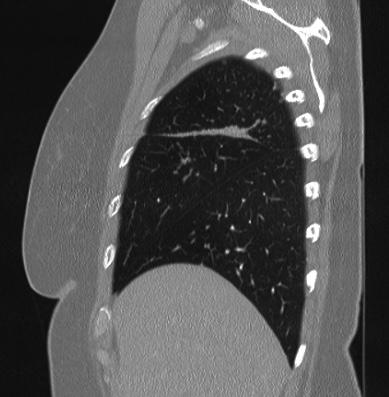 Cardiac sarcoidosis (Radiopaedia 74548-85534 Sagittal lung window 77).jpg