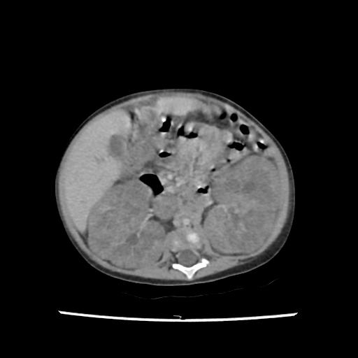 Caroli disease with autosomal recessive polycystic kidney disease (ARPKD) (Radiopaedia 89651-106703 B 113).jpg