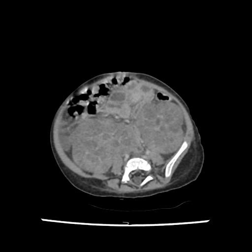 File:Caroli disease with autosomal recessive polycystic kidney disease (ARPKD) (Radiopaedia 89651-106703 B 156).jpg