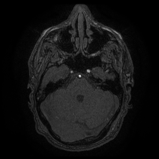 Carotid arterial dissection with acute cerebral infarction (Radiopaedia 26636-26784 MRA 127).jpg