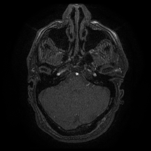 Carotid arterial dissection with acute cerebral infarction (Radiopaedia 26636-26784 MRA 138).jpg