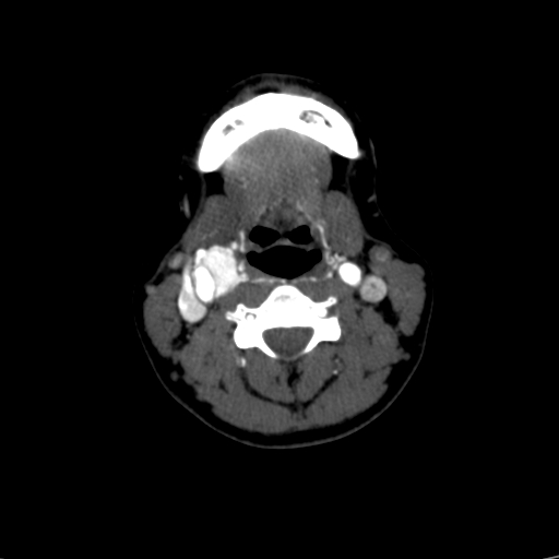 File:Carotid body tumor (Radiopaedia 39845-42300 B 31).jpg