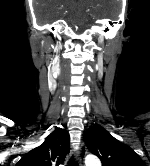 File:Carotid body tumor (Radiopaedia 39845-42300 C 56).jpg