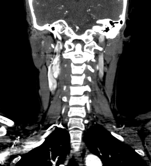 File:Carotid body tumor (Radiopaedia 39845-42300 C 57).jpg