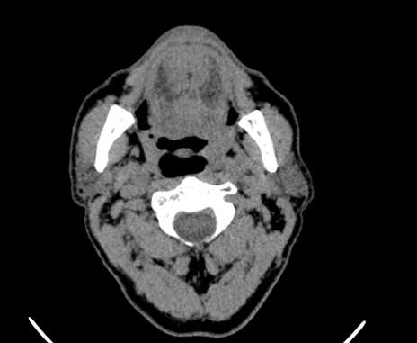 Carotid body tumor (Radiopaedia 61750-69757 Axial non-contrast 26).jpg
