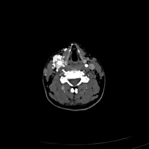 Carotid body tumor (Radiopaedia 83615-98727 A 72).jpg