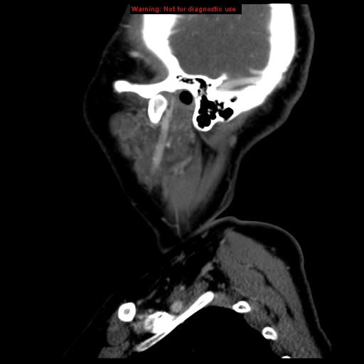 Carotid body tumor with lung metastases (Radiopaedia 9301-9986 Sagittal C+ delayed 47).jpg
