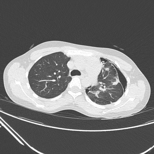 Catamenial pneumothorax (Radiopaedia 27946-28197 lung window 58).jpg