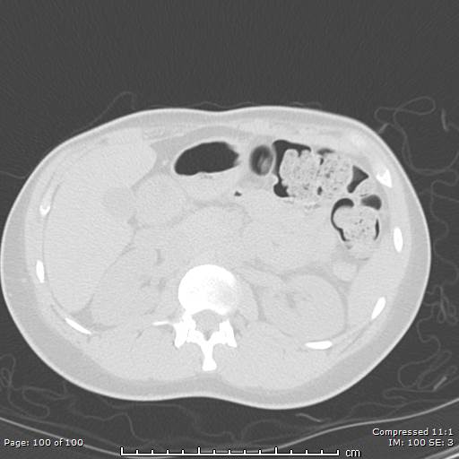 Catamenial pneumothorax (Radiopaedia 54382-60600 Axial non-contrast 100).jpg