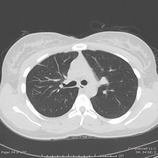 File:Catamenial pneumothorax (Radiopaedia 54382-60600 Axial non-contrast 34).jpg