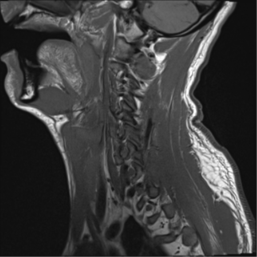 File:Cavernoma of cervical cord (Radiopaedia 50838-56347 Sagittal T1 15).png