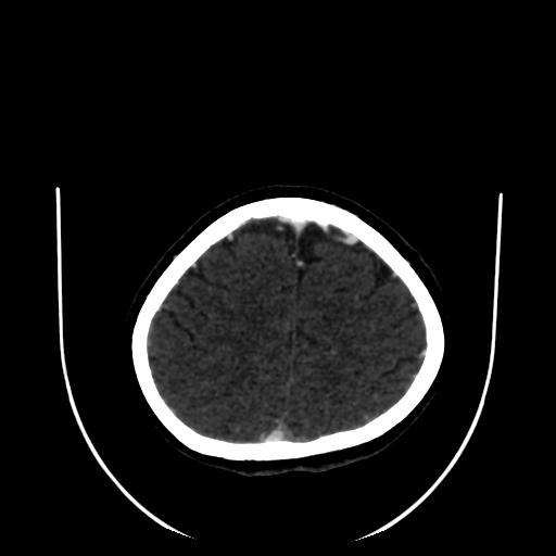 Cavernoma with developmental venous anomaly (Radiopaedia 22470-22506 C 161).jpg