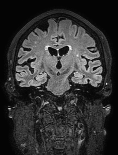 Cavernous hemangioma of the cerebellar falx (Radiopaedia 73025-83724 Coronal FLAIR 180).jpg