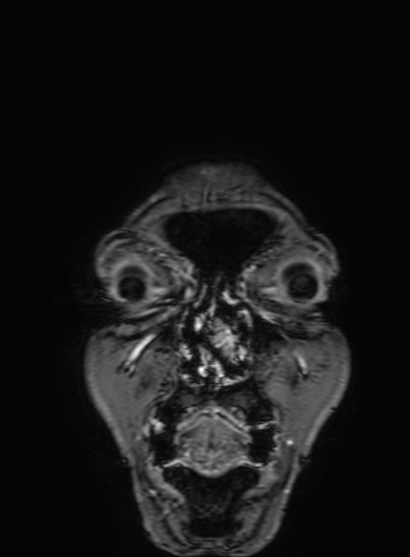 Cavernous hemangioma of the cerebellar falx (Radiopaedia 73025-83724 Coronal T1 C+ 14).jpg