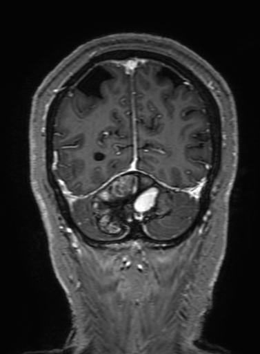 Cavernous hemangioma of the cerebellar falx (Radiopaedia 73025-83724 Coronal T1 C+ 314).jpg
