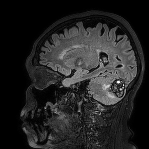 Cavernous hemangioma of the cerebellar falx (Radiopaedia 73025-83724 Sagittal FLAIR 144).jpg