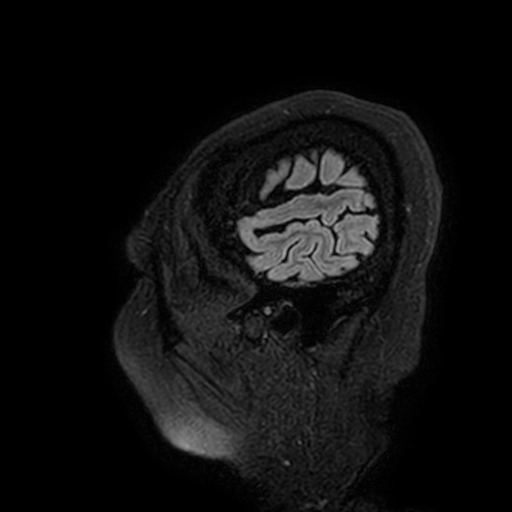 Cavernous hemangioma of the cerebellar falx (Radiopaedia 73025-83724 Sagittal FLAIR 7).jpg