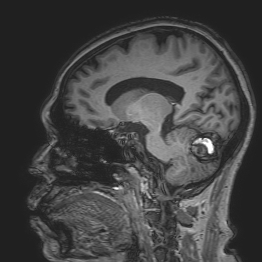 File:Cavernous hemangioma of the cerebellar falx (Radiopaedia 73025-83724 Sagittal T1 90).jpg